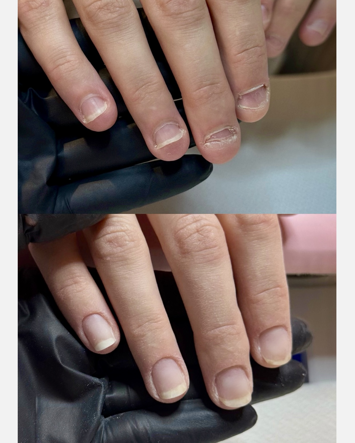 Nagelbitning behandling